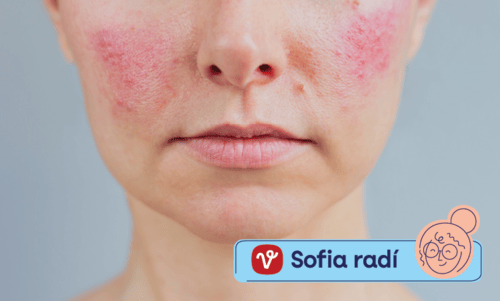 Rosacea: Ako vyzerá a dá sa vyliečiť?