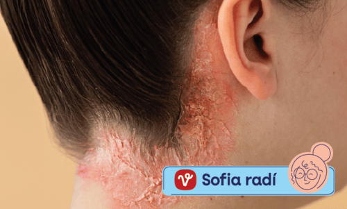 Impetigo: Príznaky, príčiny a liečba